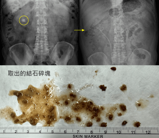 腎結石新型軟式輸尿管鏡手術