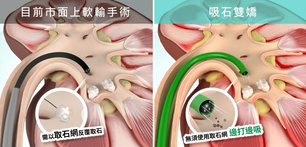 一般軟輸與新型軟式輸尿管鏡手術比較