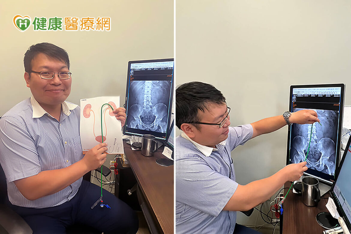 黃煒軒醫師使用軟式輸尿管內視鏡手術治療腎結石