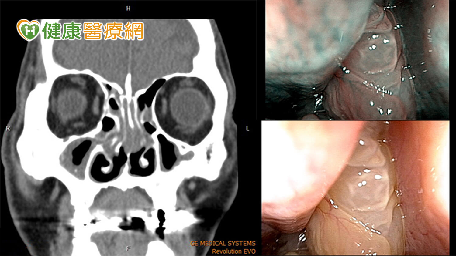 巫承融醫師鼻竇炎內視鏡手術搭配膠原蛋白基質