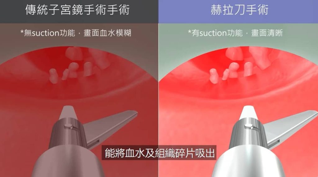 赫拉刀 Suction 吸引功能，醫生進行子宮鏡手術時視野更清晰