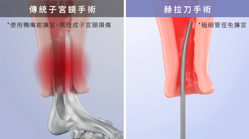 傳統子宮鏡擴宮 & 赫拉刀細徑免擴宮比較