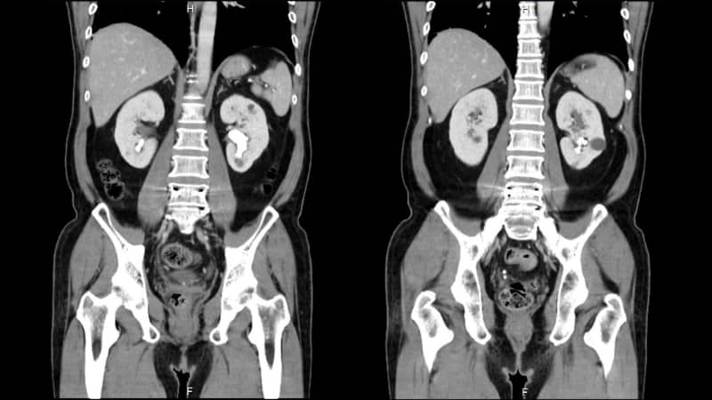 圖示：術前影像顯示楊先生雙腎佈滿結石，左側更藏有長達 3 公分的巨大鹿角結石